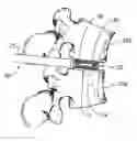 Fig. 01 - INTERVERTEBRAL IMPLANT AND TOOL FOR PLACING SAME