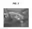 Fig. 04 - MEDICAL DEVICES WITH GALVANIC PARTICULATES
