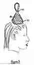 Fig. 04 - Method and kit for the multiple treatment of a head of hair
