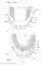 Fig. 02 - Palate-Free Upper Denture