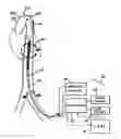 Fig. 01 - Intra-aortic balloon counterpulsation with concurrent hypothermia