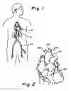 Fig. 02 - Intra-aortic balloon counterpulsation with concurrent hypothermia