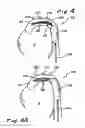 Fig. 04 - Intra-aortic balloon counterpulsation with concurrent hypothermia