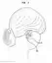 Fig. 02 - Transcutaneous bone conduction system