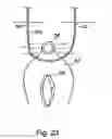 Fig. 22 - Systems, devices, and methods for minimally invasive pelvic surgery