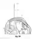 Fig. 07 - Expandable spinal access instruments and methods of use