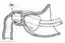 Fig. 01 - STOMACH-SPANNING GASTRIC IMPLANTS