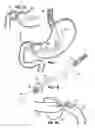 Fig. 02 - STOMACH-SPANNING GASTRIC IMPLANTS