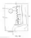 Fig. 44 - System for providing surgical access