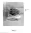Fig. 08 - Delivery of a solid body and/or a fluid using a linear Lorentz-force actuated needle-free jet injection system