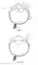 Fig. 02 - Implantable therapeutic device