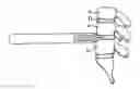 Fig. 01 - Spinal surgery distraction with an integrated retractor