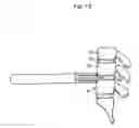 Fig. 09 - Spinal surgery distraction with an integrated retractor