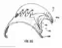 Fig. 32 - Apparatus and Method for Compressing Body Tissue