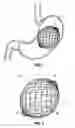 Fig. 02 - Intragastric implants with collapsible frames