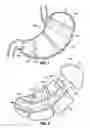 Fig. 02 - Space-filling intragastric implants with fluid flow