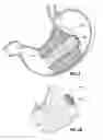 Fig. 06 - Space-filling intragastric implants with fluid flow