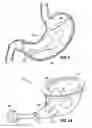 Fig. 07 - Space-filling intragastric implants with fluid flow