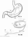 Fig. 08 - Space-filling intragastric implants with fluid flow