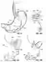 Fig. 09 - Space-filling intragastric implants with fluid flow