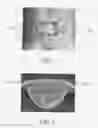Fig. 02 - METHOD FOR TREATING DEGENERATIVE DISC DISEASE USING NONINVASIVE CAPACITIVELY COUPLED ELECTRICAL STIMULATION DEVICE
