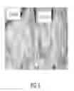 Fig. 09 - Device For Irradiating An Internal Body Surface