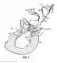 Fig. 02 - HEART VALVE REPAIR APPARATUS AND METHODS