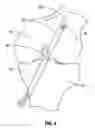 Fig. 04 - APPARATUS AND METHOD FOR RECONSTRUCTING A LIGAMENT