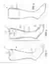 Fig. 02 - Skin-Like Prosthesis Cover Having Substantially Permanently Attached and Releasably Attached Portions