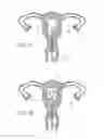 Fig. 07 - Intrauterine device