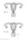 Fig. 08 - Intrauterine device