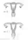 Fig. 09 - Intrauterine device