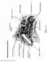 Fig. 11 - Methods and devices for delivery of pharmaceutical agents within orifices of the body