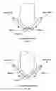 Fig. 07 - Adjustable tourniquet for venous flow control