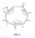 Fig. 04 - SEMI-RIGID COMPRESSION SPLINT FOR APPLICATION OF THREE-DIMENSIONAL FORCE