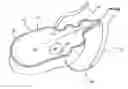 Fig. 01 - Bronchoscopic lung volume reduction method