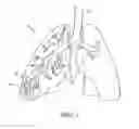 Fig. 02 - Bronchoscopic lung volume reduction method