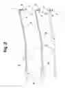 Fig. 03 - Sinusal guide cannula and kit for irrigation, suction and washing