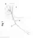 Fig. 08 - Sinusal guide cannula and kit for irrigation, suction and washing