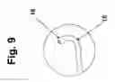 Fig. 10 - Sinusal guide cannula and kit for irrigation, suction and washing