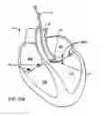 Fig. 13 - DEFLECTABLE GUIDE