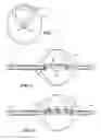 Fig. 03 - Balloon catheter with deformable fluid delivery conduit