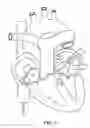 Fig. 04 - Balloon catheter with deformable fluid delivery conduit