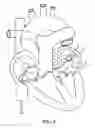 Fig. 05 - Balloon catheter with deformable fluid delivery conduit