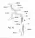 Fig. 27 - Systems and methods for removing obstructive matter from body lumens and treating vascular defects