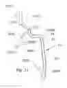 Fig. 28 - Systems and methods for removing obstructive matter from body lumens and treating vascular defects