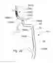 Fig. 29 - Systems and methods for removing obstructive matter from body lumens and treating vascular defects