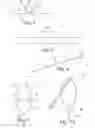 Fig. 03 - Length of self-retaining suture and method and device for using the same