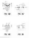 Fig. 04 - Surgical suture system