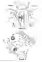 Fig. 04 - SPINOUS PROCESS IMPLANT AND METHOD OF FIXATION